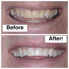 Metro smiles offers philips zoom whitespeed, the best and most effective professional teeth whitening system. Discover Zoom Teeth Whitening At North Seattle Dental