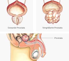 Reviews common tests for these conditions, as well as treatment side effects. Gutartige Vergrosserung Der Prostata Klinikum Forchheim