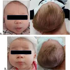 Image result for Positional Head Deformity