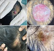 Image result for Pyogenic Granuloma