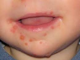 Image result for Herpes Simplex