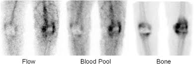 Image result for Osteomyelitis Bone Scan