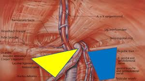 Groin muscles diagram anatomy of groin area photos muscles of the groin diagram human. Figure 2 Modified Tapp Is The Standard Procedure For Complex Inguinal And Femoral Hernias Late Results And Patient Satisfaction Springerlink