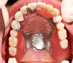 Costs, process and more how much do dentures cost? Cost Of Partial Dentures In The Philippines Worth It Asian Sun Dental Clinic Manila