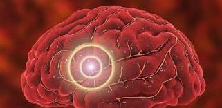 An aortic aneurysm is a bulge in the main vessel that supplies blood to your body. Que Es El Aneurisma Cerebral Sintomas Causas Y Como Tratar La Enfermedad