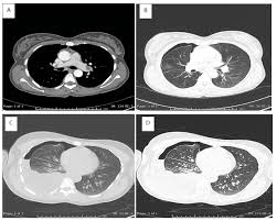 Learn more about the types, symptoms, causes, diagnosis, stages, treatment. A 3d Ct Pulmonary Angiogram A Filling Defect Seen In The Left Main Download Scientific Diagram