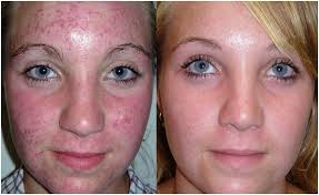 The majority of birth control pills use ethinyl estradiol as the estrogen ingredient. Birth Control For Weight Loss And Acne Weightlosslook