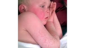Image result for red rash face