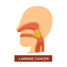 Mucus picks up dust particles, bacteria and other pollutants. Laringe Cancer Illness Malignant Tumor In Throat Stock Vector Illustration Of Medical Growth 137452741