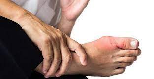 Jika bunion tumbuh, jempol kaki dapat menekan jari kaki sebelahnya. 10 Ciri Dan Gejala Asam Urat Agar Tidak Sampai Tinggi