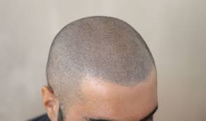 La micropigmentazione capelli deve quindi essere eseguita in. Tricopigmentazione Capelli Come Funziona Quanto Costa E Libri Cadutacapellistop It