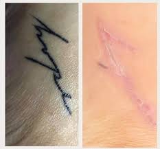If anyone know of anyone that could remove without scars please contact me. Xtract Non Laser Holistic Tattoo Removal Sophia Wyatt