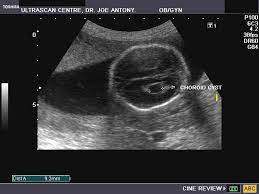 Pin On Fetus