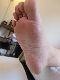 Image result for Koilonychia feet