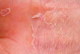 Rash 101 The Most Common Types Of Skin Rashes Treatment