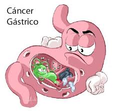 Resultado de imagen para causas del cancer al estomago