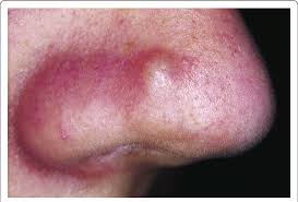 Image result for Papule