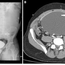 Pdf Csf Shunt Complications What The Abdominal Imager Needs To Know