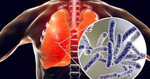 La légionellose est une infection respiratoire provoquée par des bactéries du genre legionella. Legionellose Maladie Du Legionnaire Definition