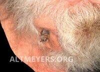 Image result for cornu cutaneum)