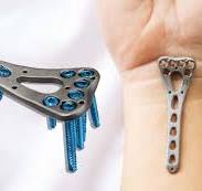 Variable Angle Locking Plates – Types and Benefits - HEMC Ortho