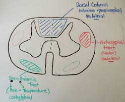 A Boring Guide To Spinal Cord Syndromes Canadiem