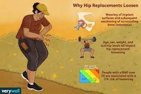 Maybe you would like to learn more about one of these? Hip Replacement Implant Loosening Symptoms