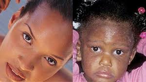 Eczema—also called atopic dermatitis—is a skin condition characterized by red, flaky, itchy skin. Don T Let Eczema Take Life Out Of Your Skin The New Times Rwanda