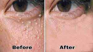 How To Get Rid Of Milia On Face 7 Way To Remove Milia On Face At Home Naturally Pimples On Face Forehead Acne Bumps Under Eyes