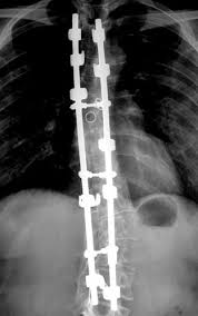 What Do I Need After Spinal Fusion Surgery Forever Fused Spinal Fusion Spinal Fusion Surgery Spinal Surgery