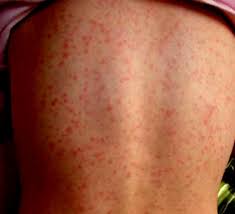 Cette pathologie est caractérisée par une éruption cutanée et buccale typique, le plus souvent associée à une angine. Scarlattina