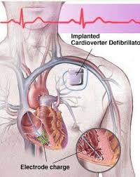 Image result for Internal Cardiac Defibrillator