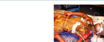 Goal is to separate thorax from abdomen effectively and improve chest wall expansion (see figure 4) iv. Chest Escharotomy