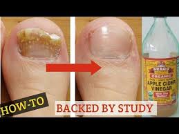 How To Use Apple Cider Vinegar For Toenail Fungus Home Remedies For Toenail Fungus Na Toenail Fungus Home Remedies Toenail Fungus Remedies Fingernail Fungus