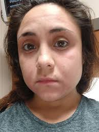 Thankfully since its an allergic reaction i got taken right in . Im so  grateful . Pray i get better soon so i can start my new job full force.