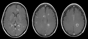 But abnormal mri results do not always mean that you have ms. Ms Advanced Coursecont4