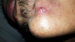 During the treatment, some clients experience hair and ingrown hair popping out. Ingrown Hairs To Watch Youtube