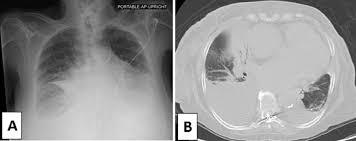The pleura are thin membranes that line the lungs and the. Non Expandable Lung An Underappreciated Cause Of Post Thoracentesis Basilar Pneumothorax Bmj Case Reports