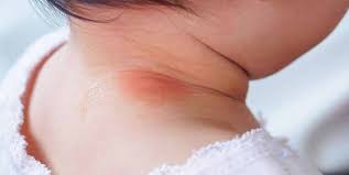Image result for sweat rash on back baby