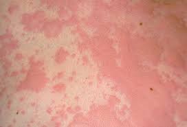 Pin On Hives Urticaria