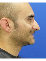 Tension Tip Ptosis 6908