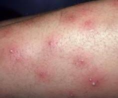 No matter your age, you've probably experienced a rash at some point in your life, but do you know how to get rid of a rash? 18 Hot Tub Folliculitis Ideas Hot Tub Tub Folliculitis Treatment