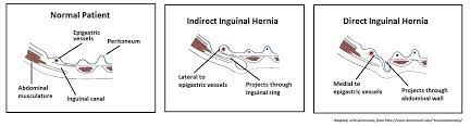 Inguinal hernias occur more o. The Inguinal Canal Boundaries Contents Teachmeanatomy