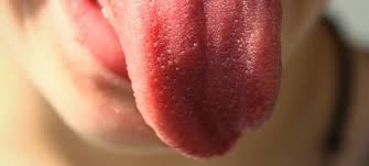 Blaschen Auf Der Zunge Hilfe Ursachen Fur Aphten Blaschen Usw