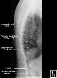 Til tross for dette forårsaker progressiv pankreatitt girdling smerte, som følges vekselvis på hver side. Vondt I Ribbeina Arsak Diagnose Rad Trening Og Behandling
