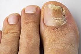 toenail subungal melanoma symptoms