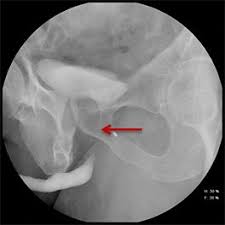 Image result for Retrograde Urethrogram