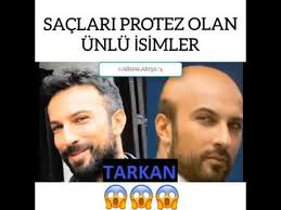 Saclari Protez Olan Unluler Nuri Alco Murat Boz Tarkan Kemal Dogulu Youtube