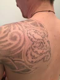 Every tattoo will have different results we post a wide variety of images to help set realistic expectations. 10 Side Effects Of Laser Tattoo Removal What You Should Know