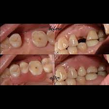 Check spelling or type a new query. Drg Albert Prawira Frs Flexible Denture Gigi Tiruan Flexible Sometimes Not Every Patient Has The Time Or Luxury To Afford Porcelain Bridge Or Implant To Replace Missing Teeth Therefore A